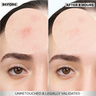 Garnier Skin Active Fast Clear 8-Hour Invisible Pimple Patch Hydrocolloid